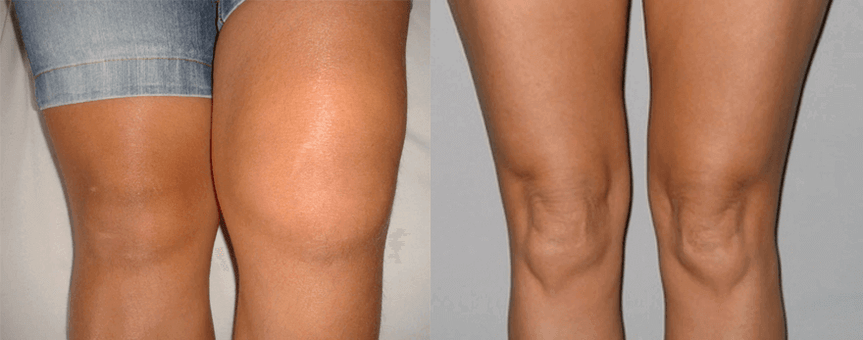 Опит с употребата на капсули Cannabis Oil преди и след употреба от Eva